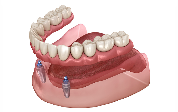 Overdenture